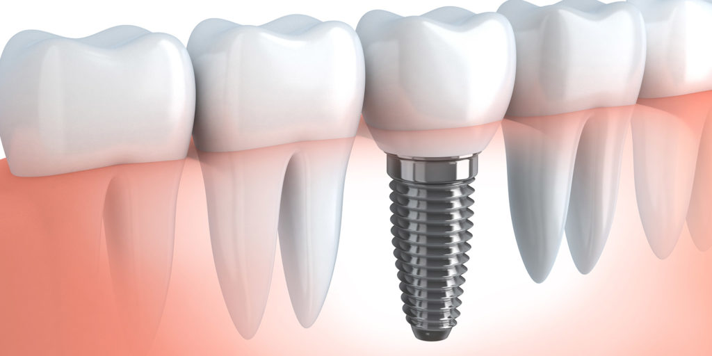 Dental implant illustration