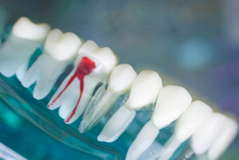 An image of an x-ray of a tooth that needs a root canal.