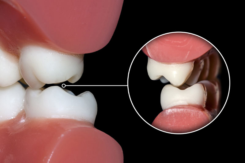 When people grind or clench their teeth, also known as bruxism, it can be very detrimental to the health of their teeth. Bruxism can happen unconsciously during the day or night. Fortunately, there are different types of procedure options available for bruxism in [city], [state] that patients can get treated with to guard their teeth. Here is a more detailed explanation of what bruxism is and how it can get treated. How Does Bruxism In [city], [state] Impact My Oral Health? When people have bruxism, it can cause their teeth to be worn down and damaged. It can even cause people to feel pain in their teeth, jaw, face, or ears. The great news is, there is a treatment option available that can be used to treat bruxism so that patients can improve the quality of their life, and most importantly, prevent additional damage to their teeth. How Do Night Guards Help Me Treat My Bruxism In [city], [state]? When people with bruxism go to a skilled and knowledgeable dental professional, they can get treated with night guards. Night guards are a customized procedure option that is worn at night to prevent grinding and clenching from waring down and causing more damage to the patient’s mouth. Those who don’t treat their bruxism with night guards are at risk of having trouble eating, speaking, and may even experience disruptions in their sleep schedule and daily activities. Come To Our Office So We Can Expertly Treat Your Bruxism Bruxism can have serious consequences if it is left untreated. This is why coming to our skilled and knowledgeable dental professional for your personalized night guards is very important. Don’t hesitate to treat your bruxism with night guards. Get in contact with our doctor, Dr.__ at our office to schedule an appointment today!