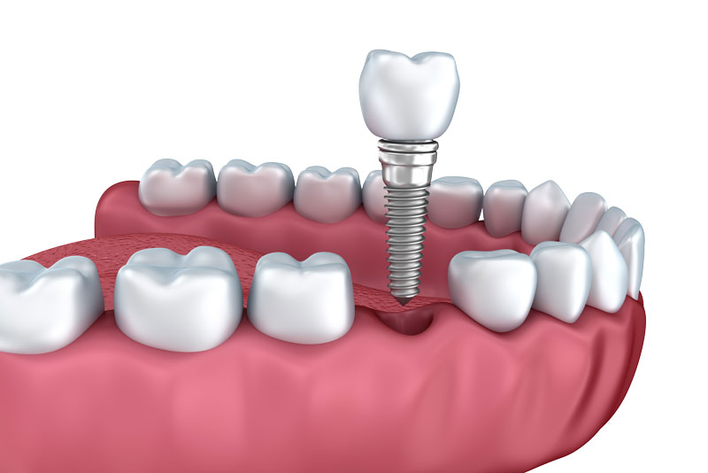 a full mouth model showing a dental implant and dental implant post.