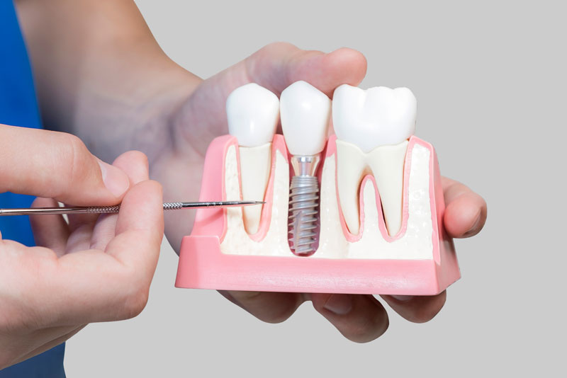 Dental Implant Model With Bone Cutaway Showing Implant Post