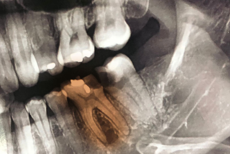 Damaged Tooth X-Ray