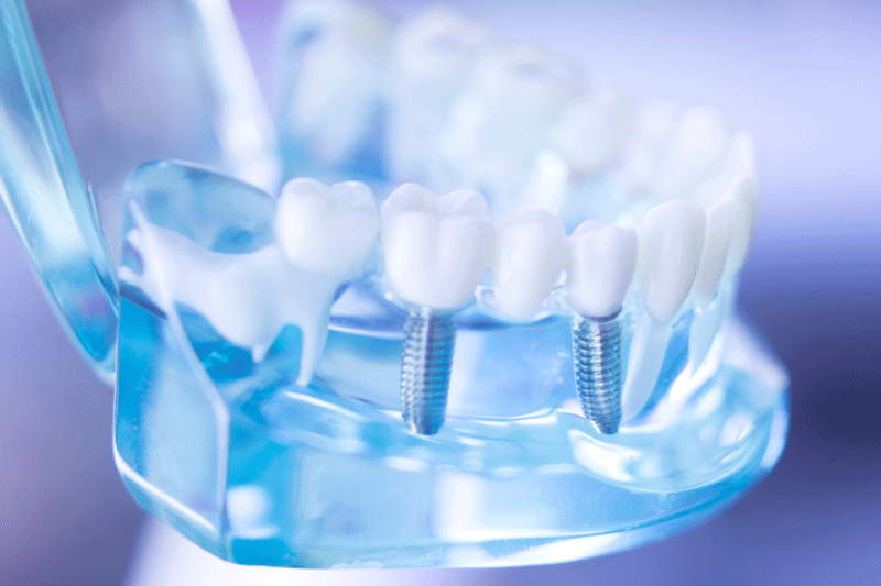 Dental clear jaw model with dental tooth implant