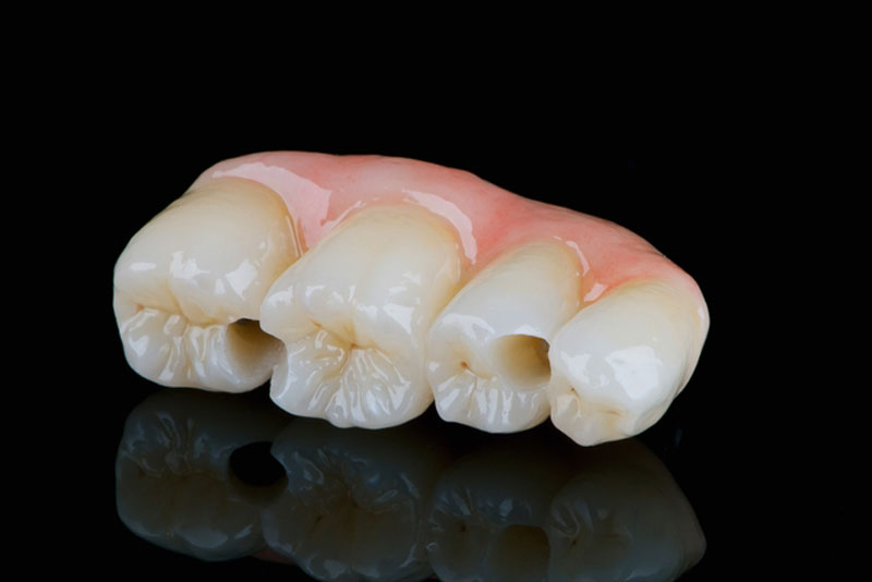 Close-up of a four-unit dental bridge with realistic tooth anatomy and pink gum base on a reflective black background.
