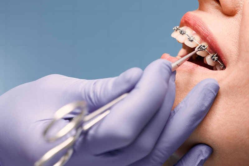 Orthodontist adjusting metal braces on a patient’s teeth during treatment. Close-up of dental care procedure for teeth alignment and oral health.