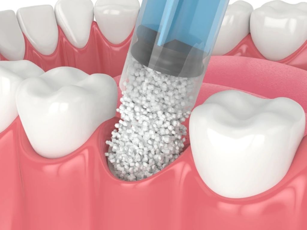 bone grafting near you
