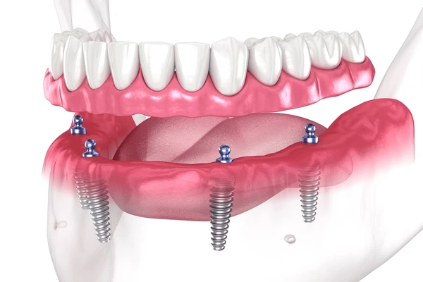 full mouth dental implants in madison and pearl, ms