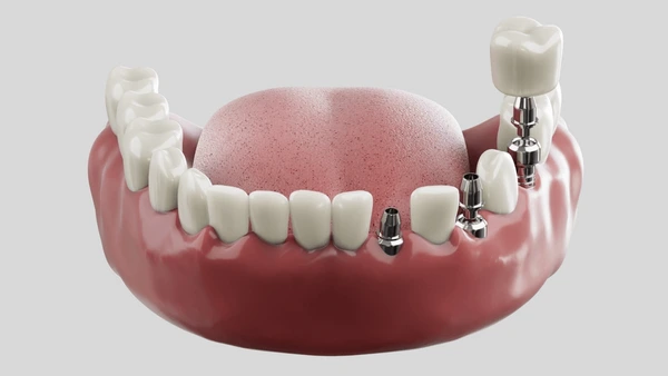 multiple dental implants near you