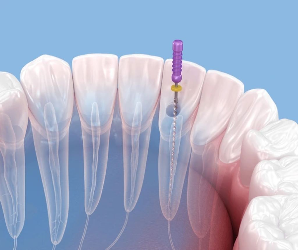 root canal treatment near you