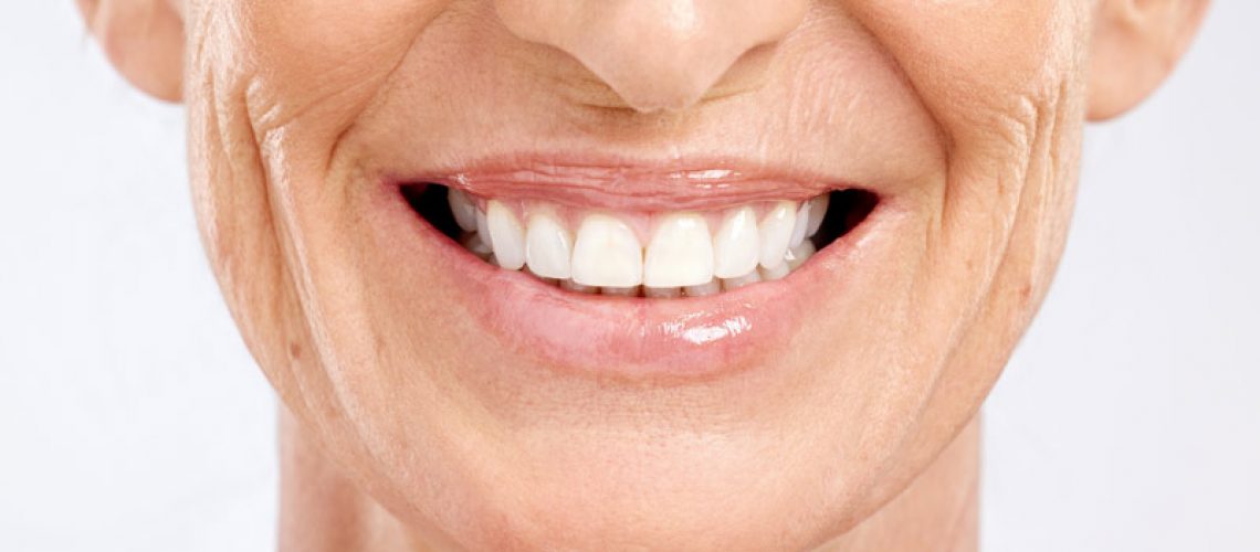 An image of an older woman smiling with porcelain veneers