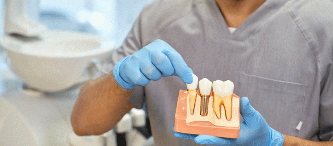 A dental doctor with a model of a dental implant in his hands