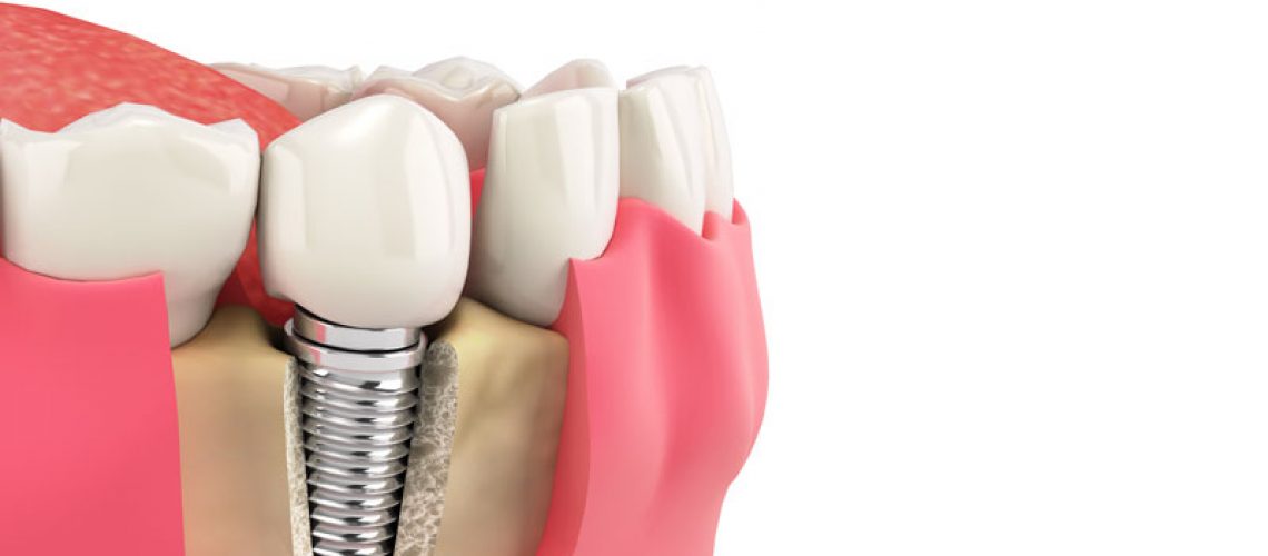 a single dental implant placed in a jawbone 3d model.