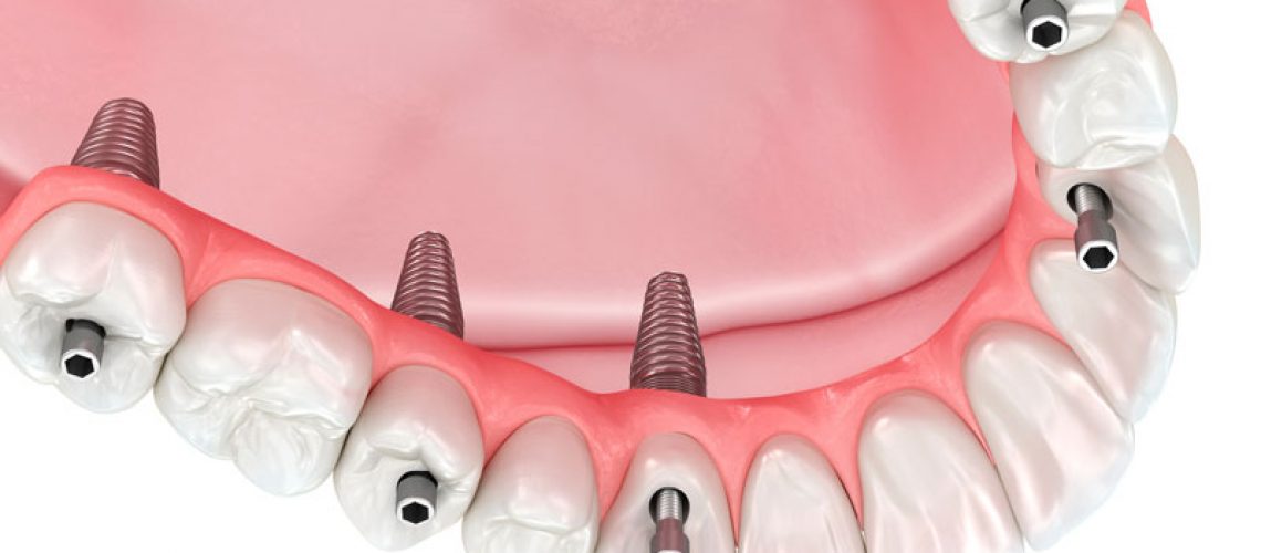 dental implant prosthetic being placed on dental implant posts.