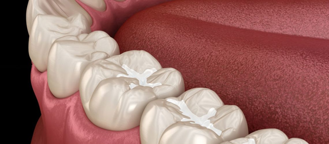 a 3D model of teeth and gums with dental sealant.
