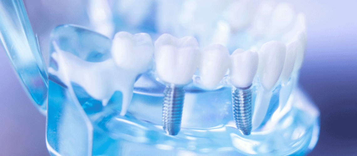 Dental clear jaw model with dental tooth implant