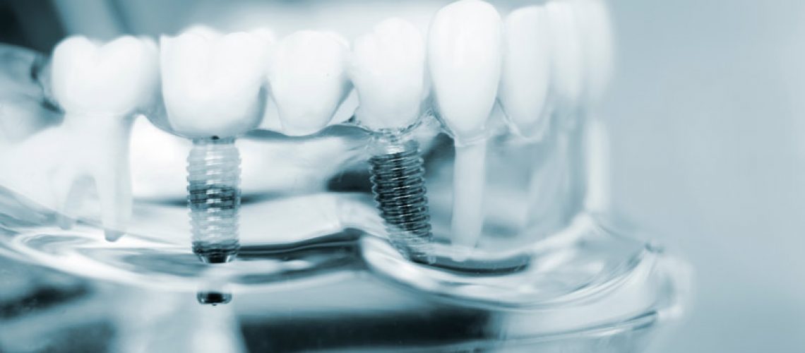 An image of a model showing dental implants.